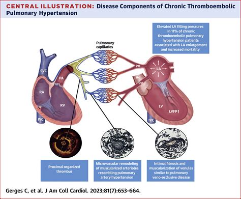 increased left ventricular filling pressure.